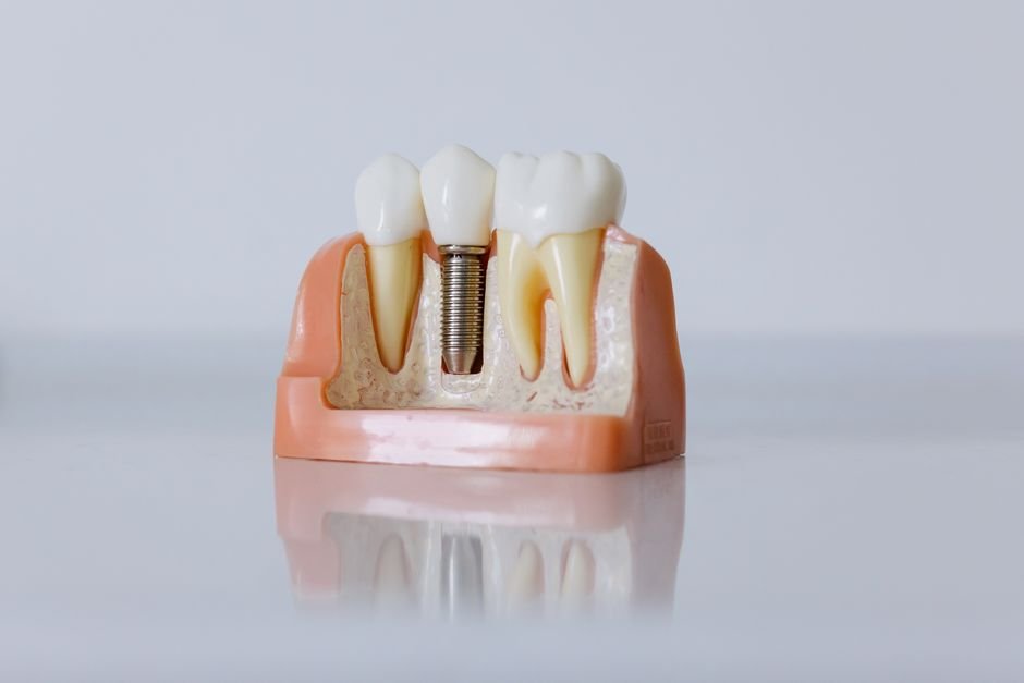 Dental Implants for Multiple Missing Teeth