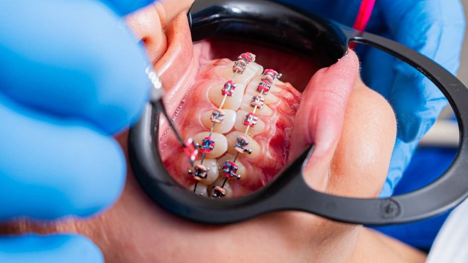 How Orthodontic Treatment Improves More Than Looks