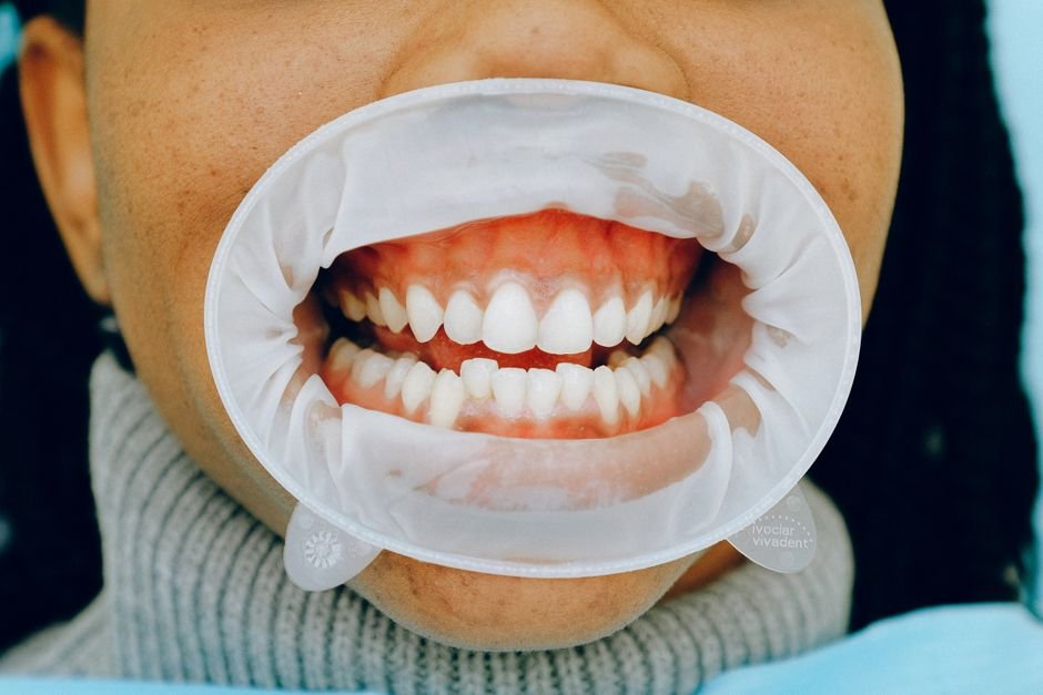The Role of Gum Health in Implant Success