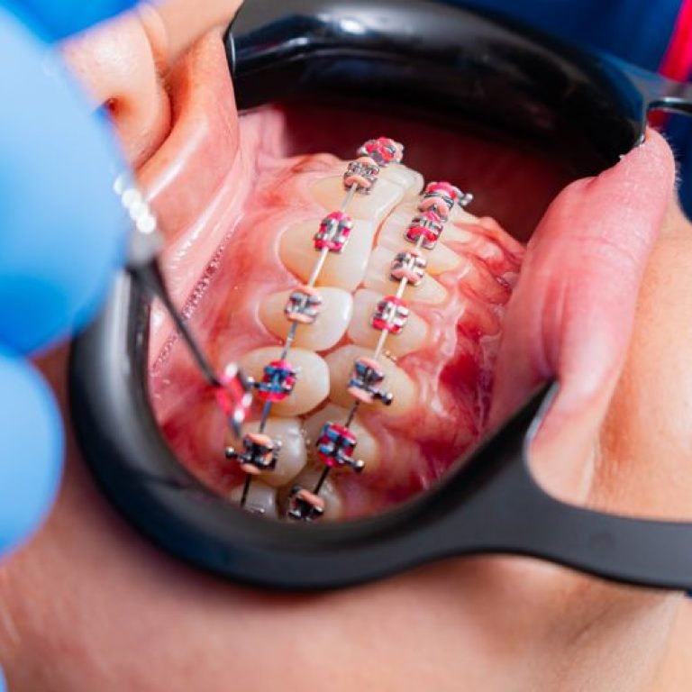 How Orthodontic Treatment Improves More Than Looks
