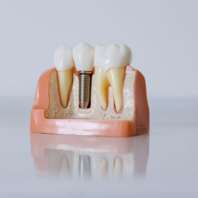 Mini Dental Implants Explained