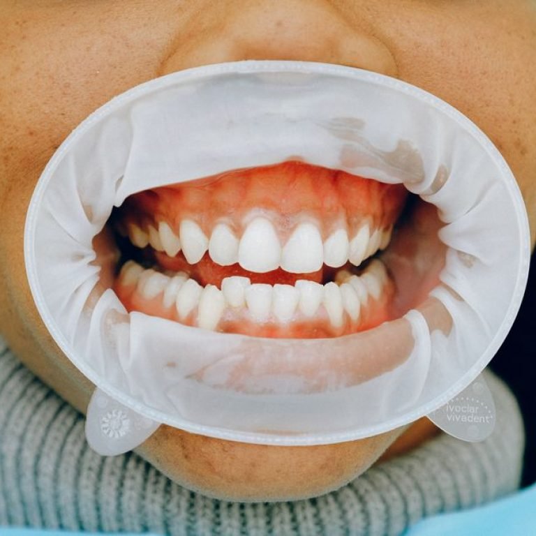 The Role of Gum Health in Implant Success