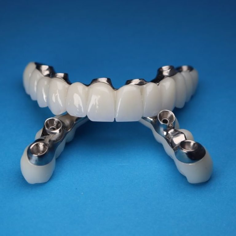 Zygomatic Implants: When Standard Implants Aren't an Option